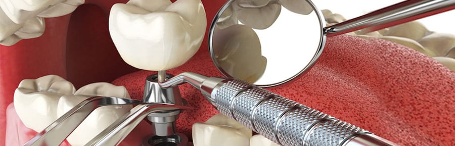 Why Bone Grafting Before Dental Implants? | Full Mouth Dental Implants